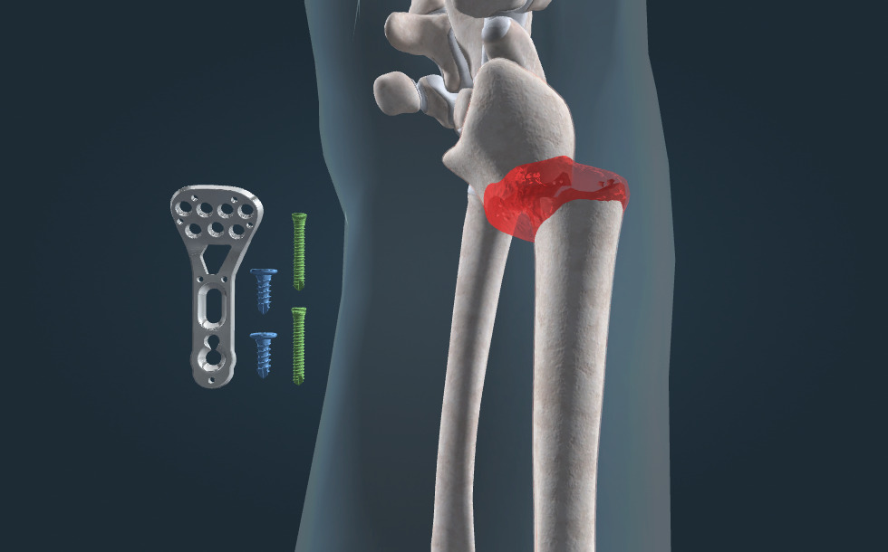 indirect-and-direct-bone-healing-3d-a-bg