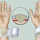 Нанасяне на артериална притискаща превръзка