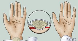 Нанасяне на артериална притискаща превръзка