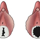 Химен при младо момиче и при жена, която води полов живот