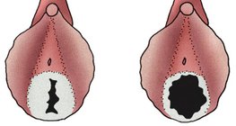 Химен при младо момиче и при жена, която води полов живот