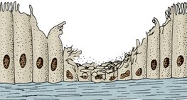 Ресничест епител от дихателните пътища на пушач