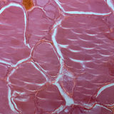 Разрез на щитовидна жлеза