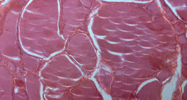 Разрез на щитовидна жлеза