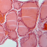 Разрез на щитовидна жлеза