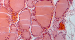 Разрез на щитовидна жлеза