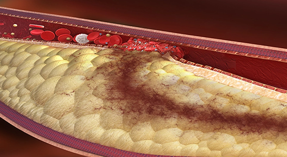 The role of physiotherapy in peripheral arterial diseases (PAD)