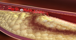 The role of physiotherapy in peripheral arterial diseases (PAD)