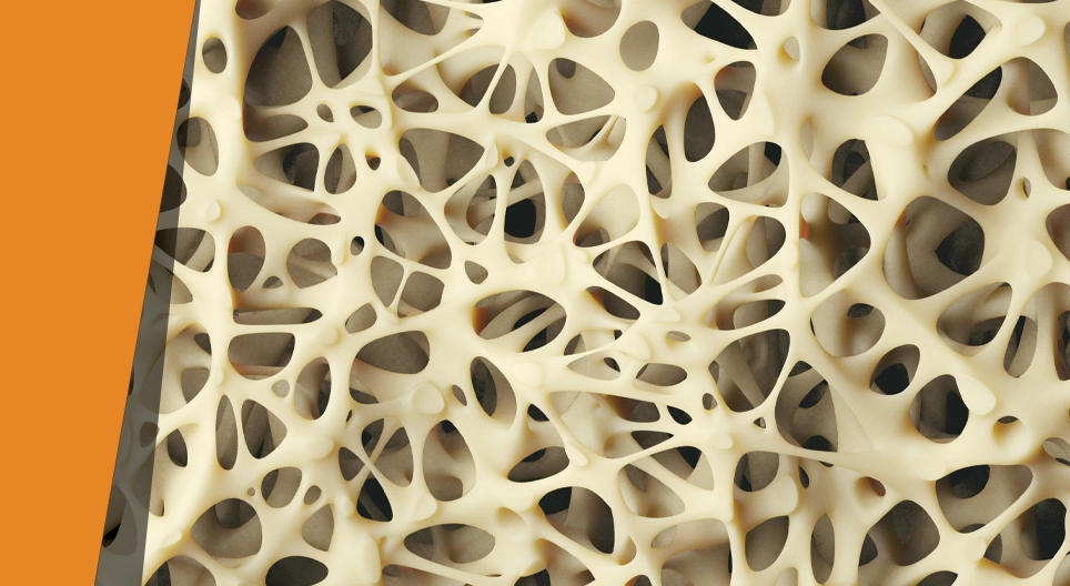 Чупливите кости
